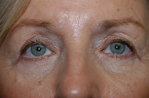 Blepharoplasty 4b
